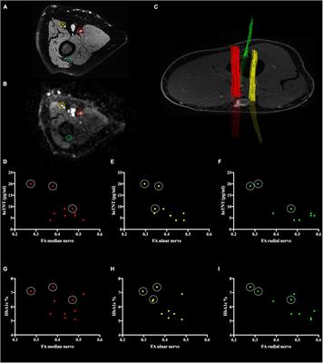 Fractional Anisotropy and Troponin T Parallel Structural Nerve Damage at the Upper Extremities in a Group of Patients With Prediabetes and Type 2 Diabetes – A Study Using 3T Magnetic Resonance Neurography